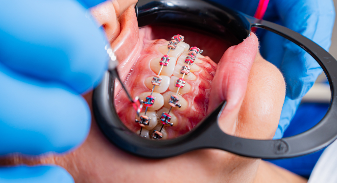 An orthodontist adjusting metal braces with colorful pink elastics on a patient during an orthodontic treatment session in Pretoria.